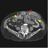 CT hernia