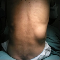 photo lumbar hernia