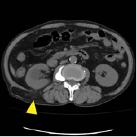 CT lumbar hernia