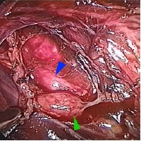 retroperitoneal cavity