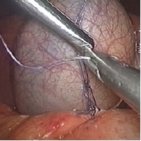 closure duodenum