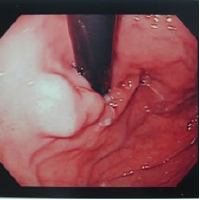 smt of stomach