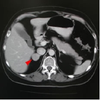 adrenal tumor