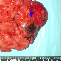 adrenal tumor2