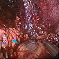 lap adrenalectomy