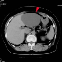 liver cyst ct