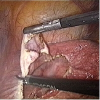 liver cyst