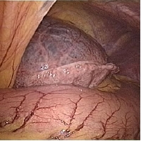 liver cyst