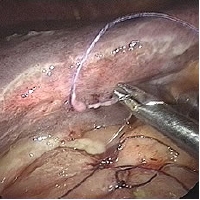 sutring of du ulcer