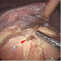 duodenal ulcer perforation