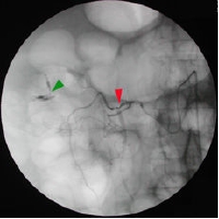 angiography