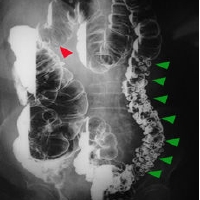 barium enema