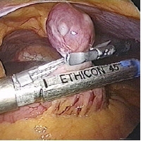 gastric wedge