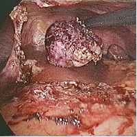 resected nodule