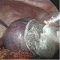 spleen cyst