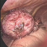 e-cyst2