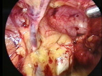 retroperitoneal cavity