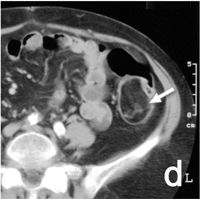 ct lipoma