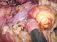 adrenal.tumor