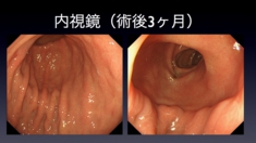 gastroduldenal anasto