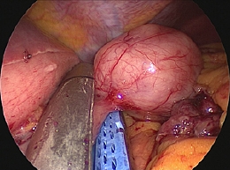 smt of stomach