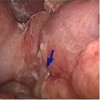 DU perforation