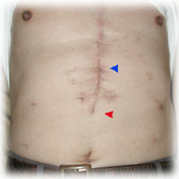 operative scar